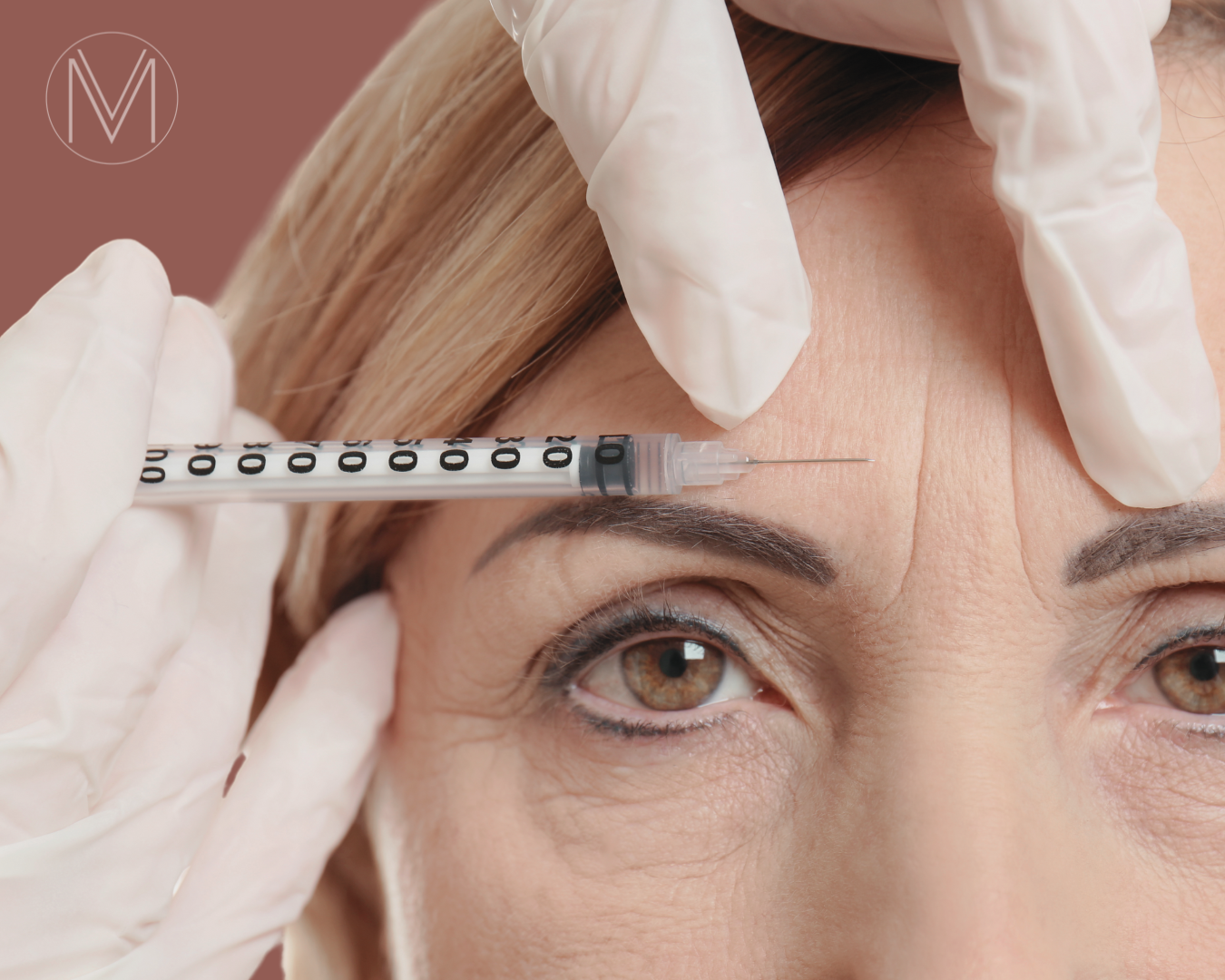 Efeitos a longo prazo da toxina botulínica tipo A (Botox) nas linhas faciais: uma comparação em gêmeos idênticos