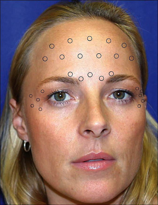 Figura 1. Locais aproximados de toxina botulínica tipo A (Botox; Allergan Inc, Irvine, Califórnia) na testa, glabelar e regiões dos pés de galinha.